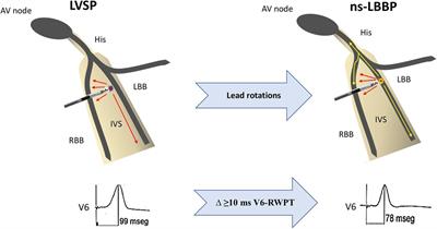 Redefining QRS transition to confirm left bundle branch capture during left bundle branch area pacing